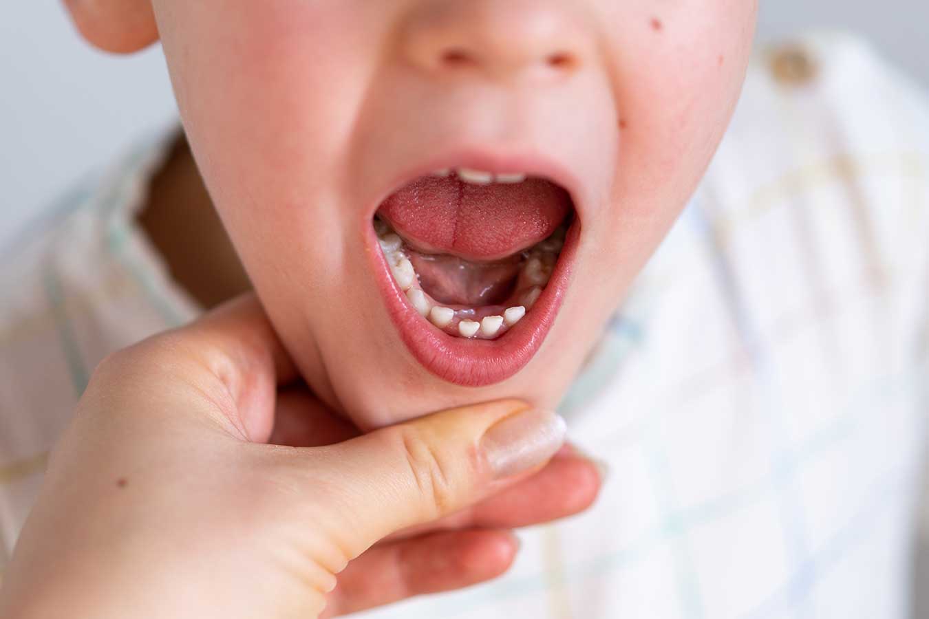 Παιδικά δόντια - Πότε πόσα ποιά δόντια βγάζουν τα παιδιά
