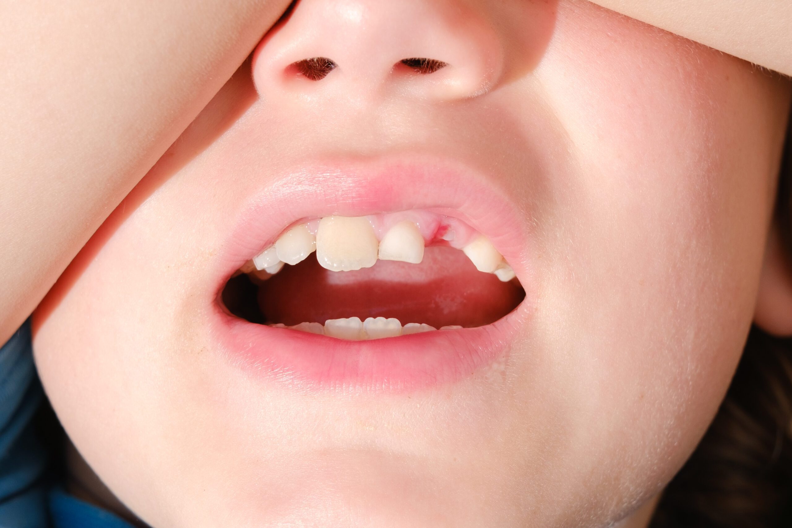 Bleeding after tooth extraction in a child